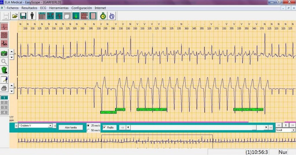 Electrocardiograma
